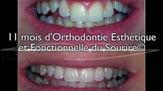 Sourire gingival sur adolescent  correction en 11 mois par aligneurs® en OEFS© [upl. by Botti]