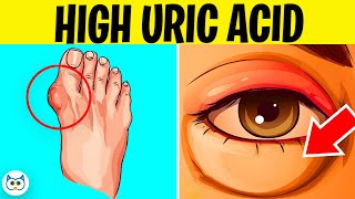 7 Symptoms of High Uric Acid Levels In The Body  Gout Symptoms [upl. by Llezniuq765]