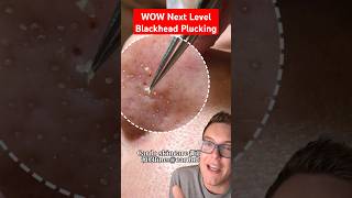 Next Level BLACKHEAD PLUCKING  Best Blackhead Removal shorts [upl. by Hullda229]