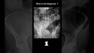 Large bowel obstruction Abdominal XrayAbnormalities Largebowel obstruction68radiologychannel007 [upl. by Clarita]