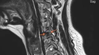 Typical disc herniation of cervical spine [upl. by Jamilla]