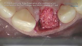 PD PhD Ronald Jung Ridge Preservation after Tooth Extraction using Geistlich Mucograft® Seal [upl. by Welsh689]