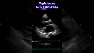 Infective Endocarditis invloving Mitral and Aortic Valve heart shorts echocardiography [upl. by Peisch203]