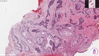 Ameloblastoma Conventionalmulticystic type [upl. by Raynold]