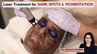 ✳️ Laser Treatment for Dark Spots amp Pigmentation ✳️Carbon Laser amp Laser Toning Treatment Procedure [upl. by Cookie]