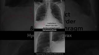 Hydropneuomothorax Chest Xray shorts [upl. by Korie]