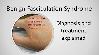 Benign Fasciculation Syndrome Causes and Treatment [upl. by Digdirb]