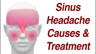 Sinus Headaches Causes amp Treatment [upl. by Hana]