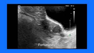 Fibroid vs LSCS Scar Dehiscence How Ultrasound and Doppler Make the Diagnosis [upl. by Agretha]