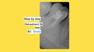 Root Canal Retreatment [upl. by Ayotac]