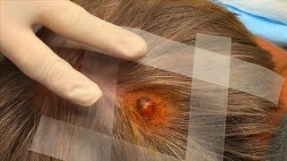 Ninis Scalp Lesion Follow Up with Dr Gilmore [upl. by Ajram]