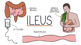 Understanding Ileus Paralytic Ileus [upl. by Ulane]