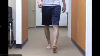 Clinical Gait Case Study Tibial Varum with Postop ACL complications [upl. by Nyad616]