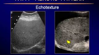 Sonography of the LiverP5flv [upl. by Anuahsed]