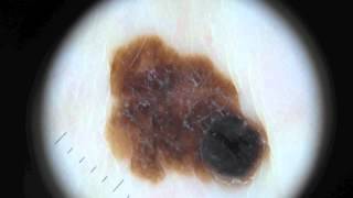 Moles and Melanoma [upl. by Anej]