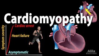 Cardiomyopathy animation [upl. by Usanis]