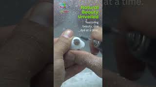 Transforming lives with artificial eyes eyes doctor prostheticeye artificialeye [upl. by Edaw]