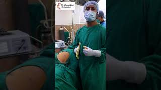 Dermoid cyst 3 port surgery Patient from Surkhet [upl. by Mistrot]