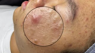 ACNE TREATMENT VU QUYNH MI Acne On Boys Chin 2024 [upl. by Nihhi]