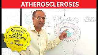 Atherosclerosis  Pathophysiology [upl. by Oderfla]