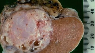 Testicular germ cell tumours  Introduction  Pathology mini tutorial [upl. by Ambert720]