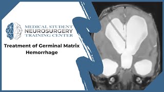 Treatment of Germinal Matrix Hemorrhage [upl. by Nawrocki830]