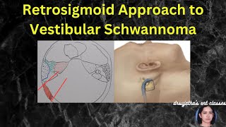 245Retrosigmoid approach to vestibular schwannoma surgeryeducation [upl. by Eimot121]