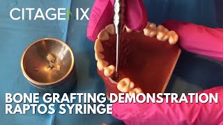 Basic Bone Grafting Procedure Demonstration With Raptos Syringe Citagenix Products  Citagenix [upl. by Aicenaj]