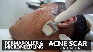 Microneedling for Acne Scars Treatment  Dermaroller Before and After  Skin Resurfacing  Dr Jason [upl. by Haraj]