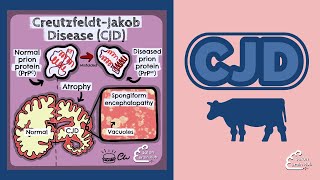 Creutzfeldt Jakob Disease CJD [upl. by Amzaj]