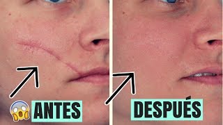 ¡MIRA COMO ELIMINÉ ESTA CICATRIZ EN 2 MINUTOS Y EN VIVO 😱100 REAL  INSTANTLY AGELESS [upl. by Wassyngton]