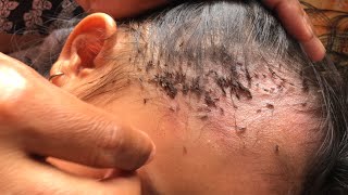 Removing Thousands Of Lice From Long Hair How To Remove It [upl. by Paulsen]