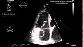 Right Atrial Thrombus [upl. by Ginger]