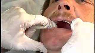 Complete Denture Procedure  20 INITIAL PLACEMENT OF THE DENTURES [upl. by Ecinehs914]