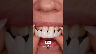 Snap On Veneers Instant Smile Makeover [upl. by Dario]