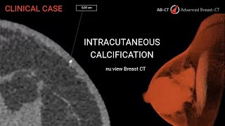 nuview Breast CT Visualization of Intracutaneous Calcification [upl. by Patin]