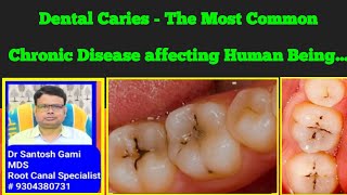 Dental Caries  The Most Common Chronic Disease affecting Human Being [upl. by Donny297]