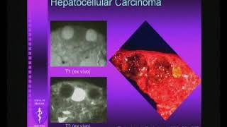 MR Imaging of Focal Liver Lesions A Case Based Approach [upl. by Amado]