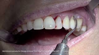 PROPHYLAXIS  Dr Gianluca Russo  Maintenance periodontal therapy [upl. by Peyter]