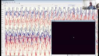 AES Professors Rounds Pediatric Epilepsy Case Studies [upl. by Concettina]