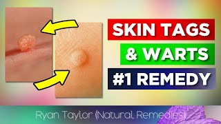 Use Iodine for Skin Tags amp Warts Removal [upl. by Lekym932]