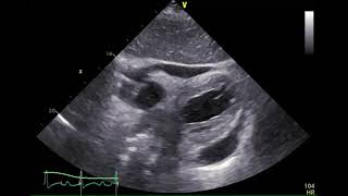 経胸壁心エコー図 心タンポナーデ 2 心窩部四腔像 [upl. by Mora]