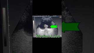 Prostatomegaly  Enlarged Prostate  Median Lobe  Urine Retention on Ultrasound [upl. by Etteuqal625]