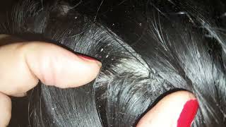 Dandruff scalp Removal Big Flakes dandruff scratching Removal scalp asmr [upl. by Ahsi]