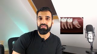 Third permanent molars what should orthodontists do [upl. by Annahpos804]