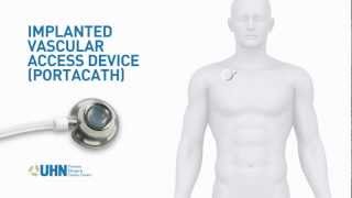 PortaCath Implanted Vascular Access Device [upl. by Attennyl168]