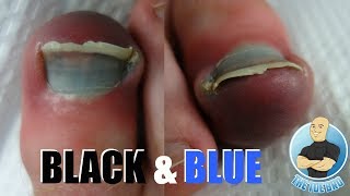 3 FOR 1 SPECIAL  INGROWN TOENAIL BRUISED TOE BLACK NAIL [upl. by Anayaran]