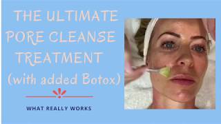 Botox to shrink your pores Yes really  Alice HartDavis [upl. by Paza]