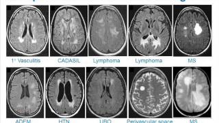 MRI Uses in MS [upl. by Nageem]