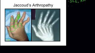 Clinical Features of SLE Jaccouds Arthropathy [upl. by Nitsyrk704]